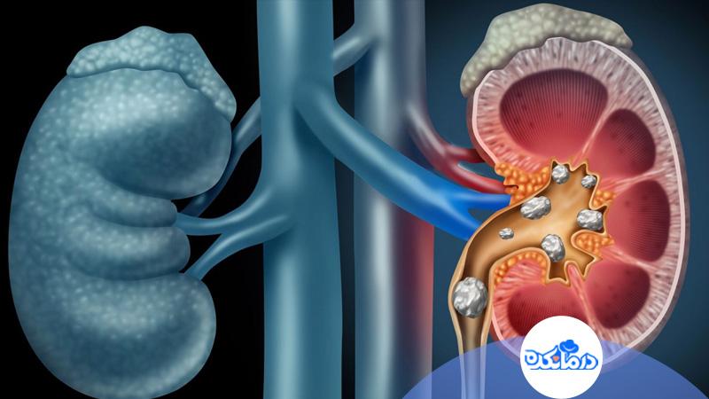 ابتلای کودکان به سنگ کلیه و راه‌کارهای درمانی آن
