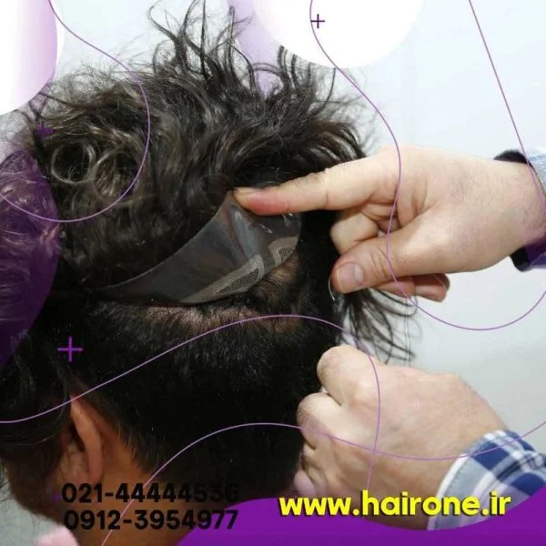 چگونه پروتز مو درست کنیم؟