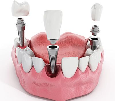 فرق بین ایمپلنت و کاشت دندان
