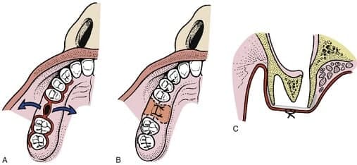 درمان سوراخ شدن سینوس دندان