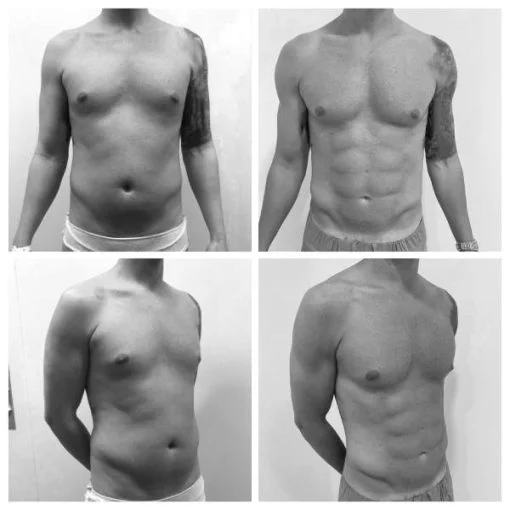 Complications of abdominal resection