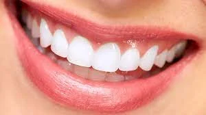 لیست قیمت لمینت دندان دولتی و خصوصی