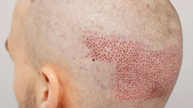 سفری به دنیای کاشت مو به روش FIT