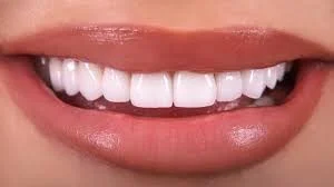 روکش ایمپلنت با طراحی طبیعی و استحکام برای بازگرداندن لبخندتان