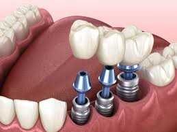 رهایی از استرس هزینه های دندانپزشکی