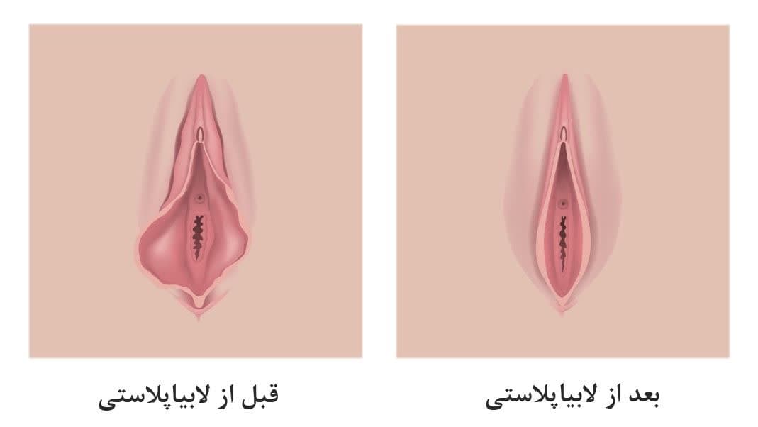 چگونه لابیا را سفید کنیم؟