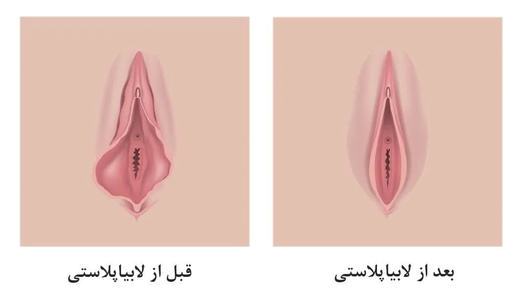 چگونه لابیا را سفید کنیم؟