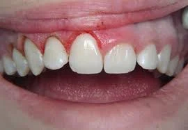 آیا لیفت لثه دائمی است؟