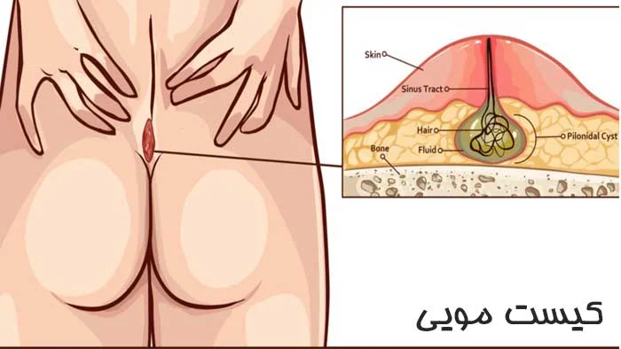 آیا کیست مویی خطرناک است