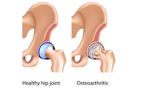 چگونه آرتروز لگن با ورزش درمان می شود؟