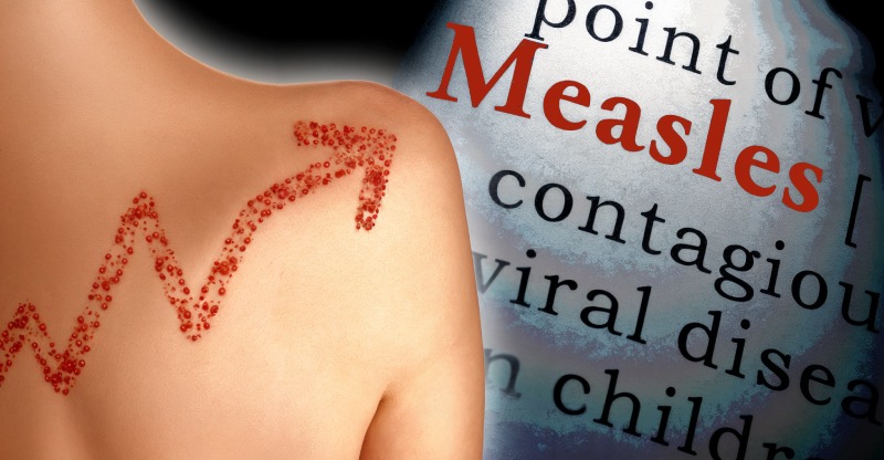 شیوع دوباره سرخک در جهان: اهمیت حیاتی واکسیناسیون